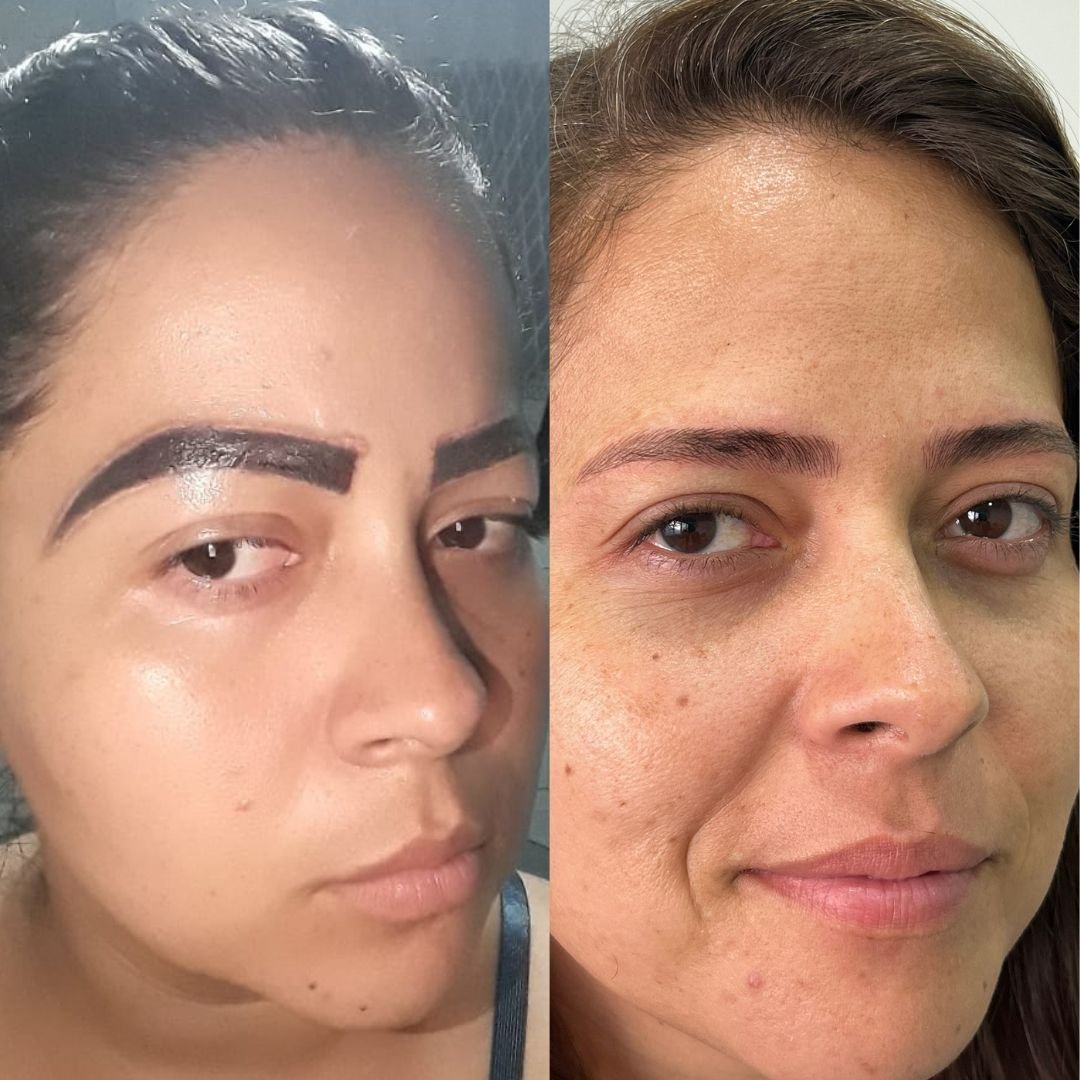 Caso Dyeny — antes e depois da despigmentação e reconstrução conduzida por Mariana Souza