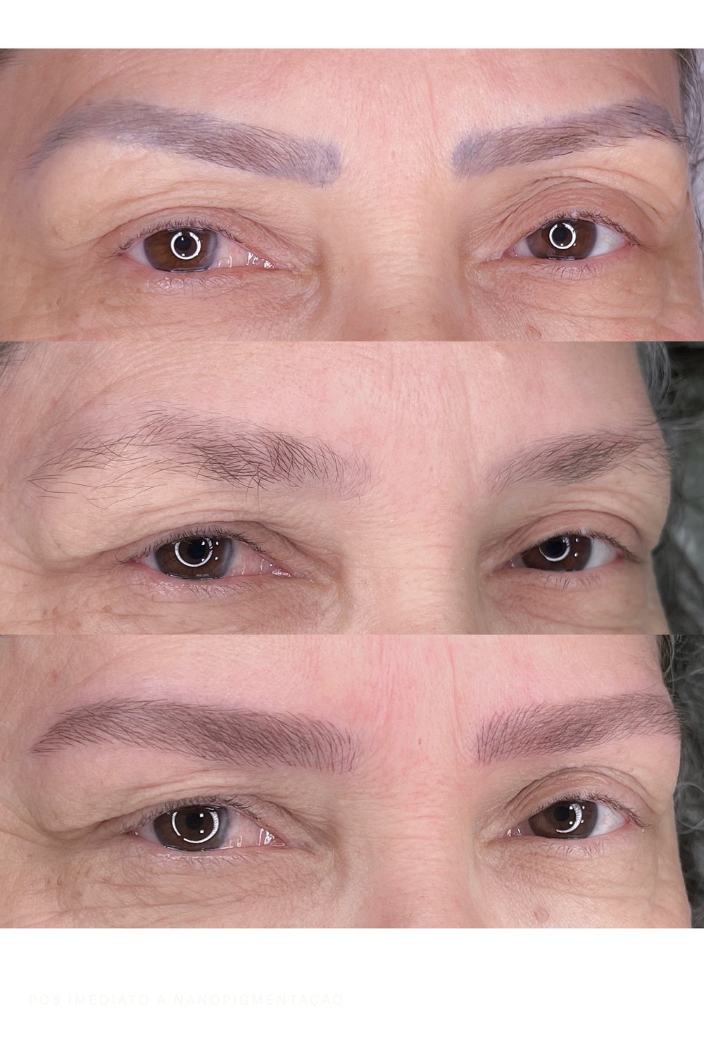 Remoção a Laser — três etapas do tratamento de despigmentação de sobrancelhas